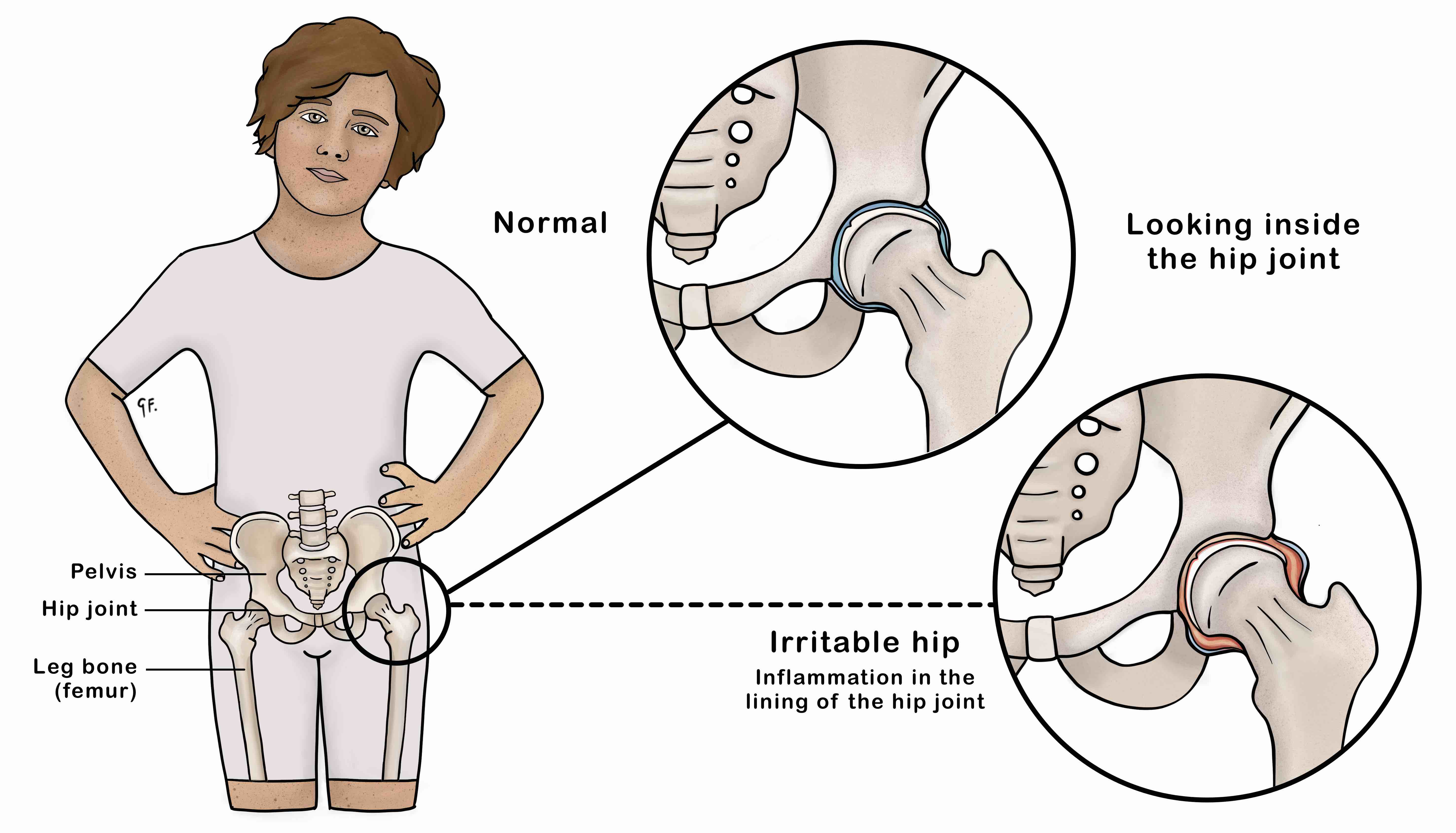 irritable-hip-in-children-kidshealth-nz